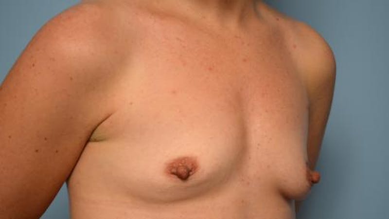 Breast Augmentation Before & After Gallery - Patient 390107 - Image 3