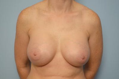 Breast Augmentation Before & After Gallery - Patient 553590 - Image 2
