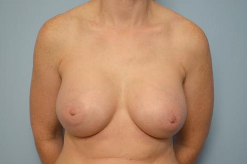 Breast Augmentation Before & After Gallery - Patient 553590 - Image 2