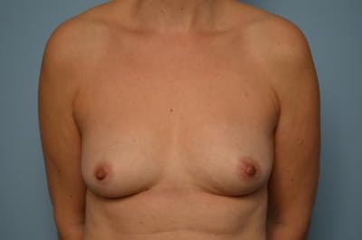 Breast Augmentation Before & After Gallery - Patient 327995 - Image 1