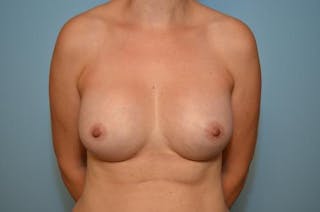 Breast Augmentation Before & After Gallery - Patient 327995 - Image 2