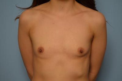 Breast Augmentation Before & After Gallery - Patient 266119 - Image 1
