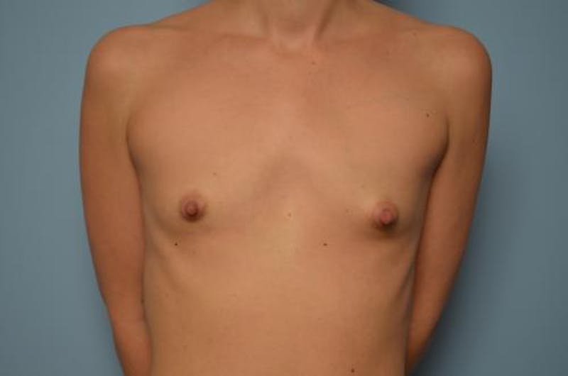 Breast Augmentation Before & After Gallery - Patient 116820 - Image 1