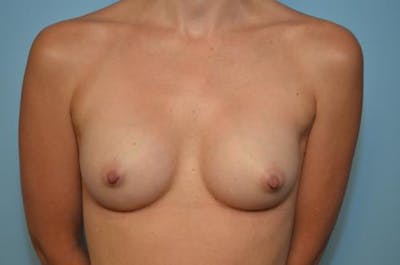 Breast Augmentation Before & After Gallery - Patient 116820 - Image 2