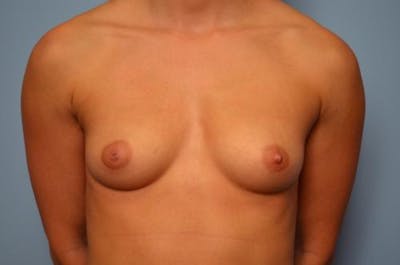 Breast Augmentation Before & After Gallery - Patient 618084 - Image 1