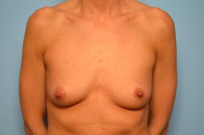 Breast Augmentation Before & After Gallery - Patient 113345 - Image 1