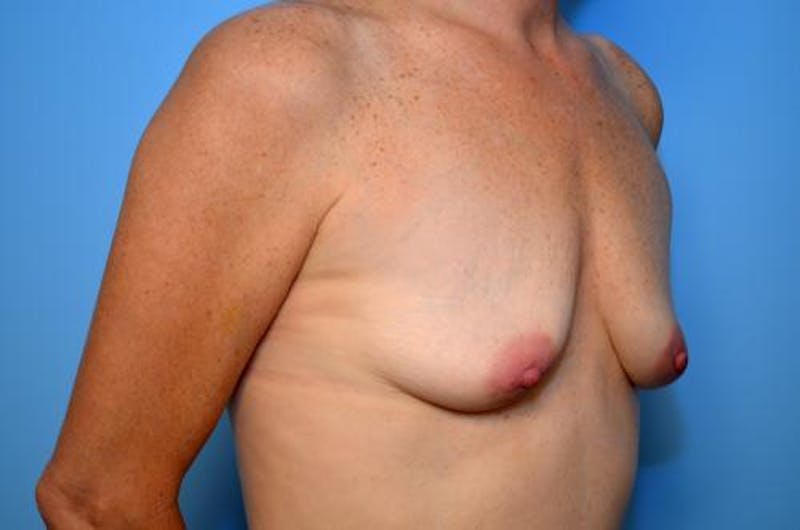 Breast Augmentation Before & After Gallery - Patient 252488 - Image 3