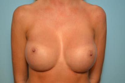 Breast Augmentation Before & After Gallery - Patient 285774 - Image 2