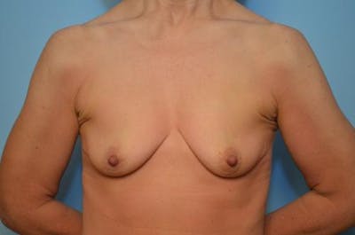 Breast Augmentation Before & After Gallery - Patient 229508 - Image 1