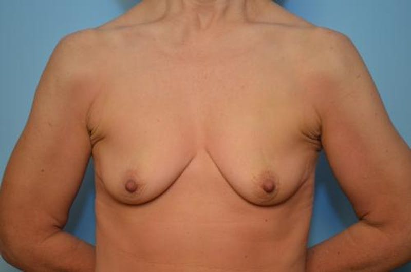 Breast Augmentation Before & After Gallery - Patient 281206 - Image 1