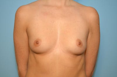 Breast Augmentation Before & After Gallery - Patient 747474 - Image 1