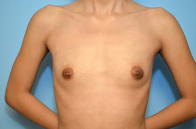 Breast Augmentation Before & After Gallery - Patient 106202 - Image 1