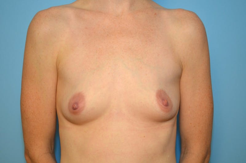 Breast Augmentation Before & After Gallery - Patient 247929 - Image 1