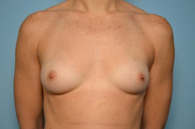 Breast Augmentation Before & After Gallery - Patient 643162 - Image 1
