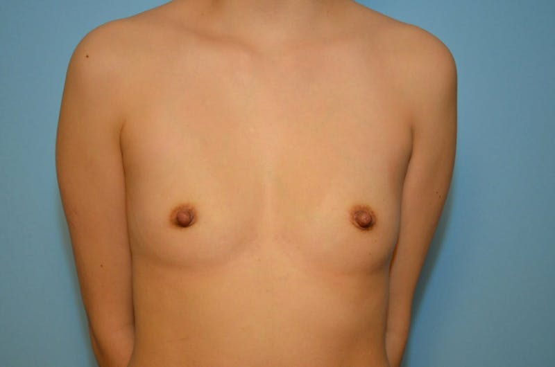 Breast Augmentation Before & After Gallery - Patient 177144 - Image 1