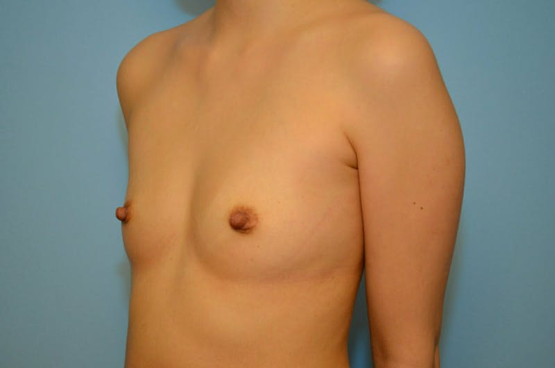 Breast Augmentation Before & After Gallery - Patient 177144 - Image 7