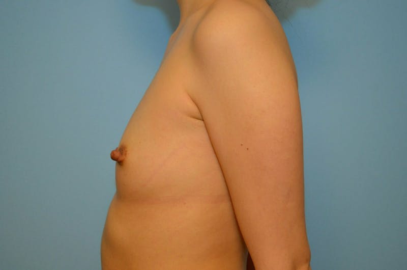 Breast Augmentation Before & After Gallery - Patient 177144 - Image 9