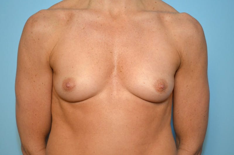 Breast Augmentation Before & After Gallery - Patient 118188 - Image 1