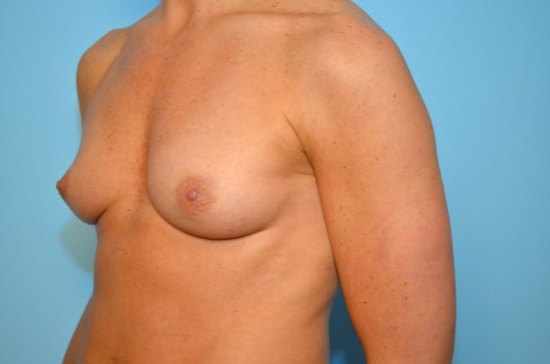 Breast Augmentation Before & After Gallery - Patient 118188 - Image 7