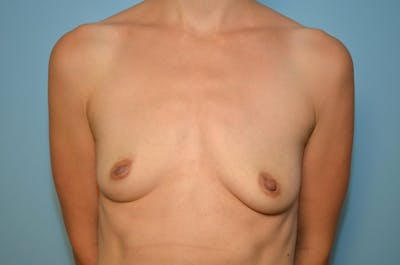 Breast Augmentation Before & After Gallery - Patient 262670 - Image 1