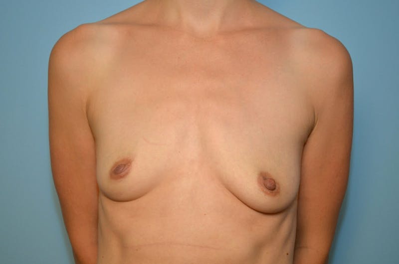 Breast Augmentation Before & After Gallery - Patient 338284 - Image 1