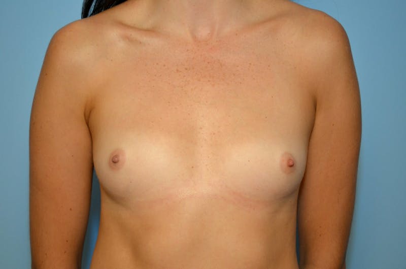 Breast Augmentation Before & After Gallery - Patient 280751 - Image 1
