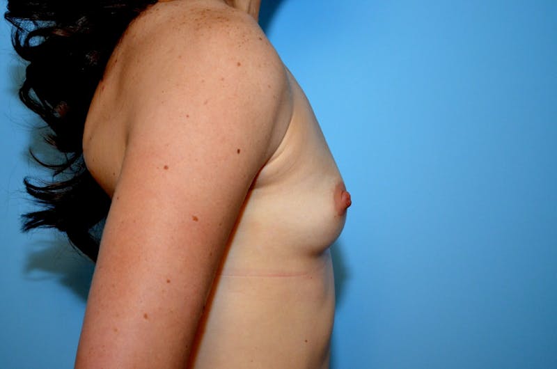 Breast Augmentation Before & After Gallery - Patient 160818 - Image 5