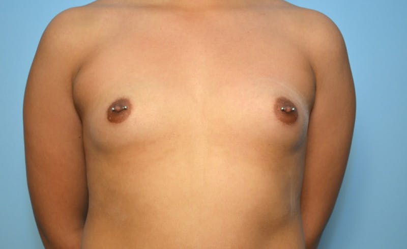 Breast Augmentation Before & After Gallery - Patient 317010 - Image 1