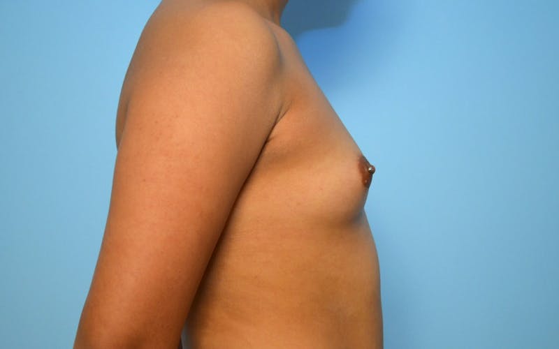 Breast Augmentation Before & After Gallery - Patient 317010 - Image 5