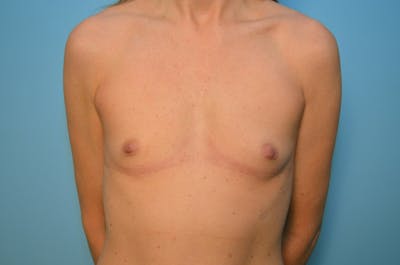 Breast Augmentation Before & After Gallery - Patient 796648 - Image 1