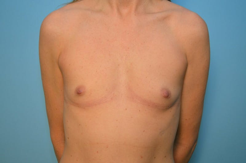 Breast Augmentation Before & After Gallery - Patient 426500 - Image 1