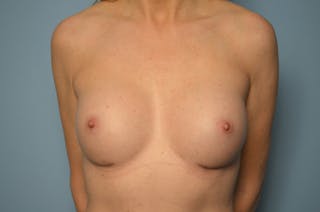Breast Augmentation Before & After Gallery - Patient 426500 - Image 2