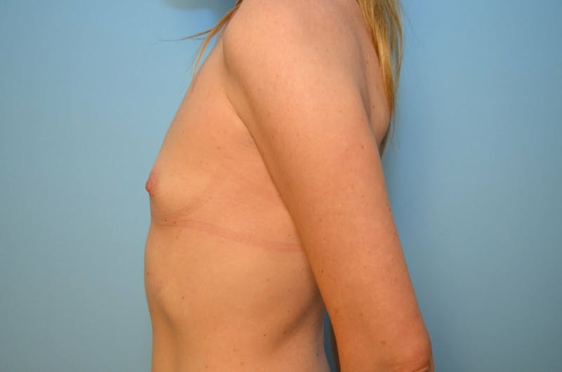 Breast Augmentation Before & After Gallery - Patient 426500 - Image 9