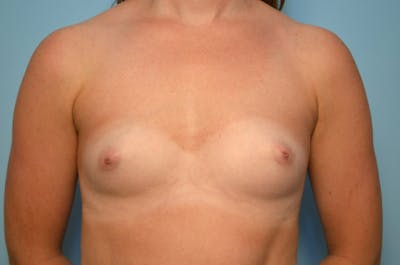 Breast Augmentation Before & After Gallery - Patient 409024 - Image 1