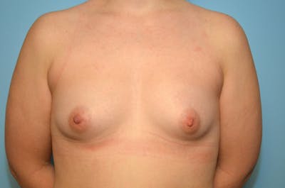 Breast Augmentation Before & After Gallery - Patient 201073 - Image 1