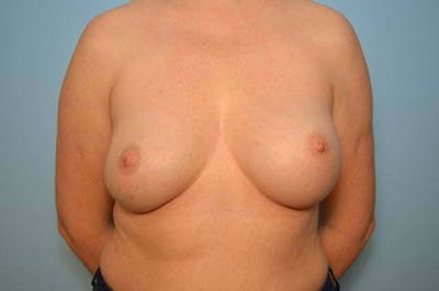 Breast Augmentation Before & After Gallery - Patient 118891 - Image 2