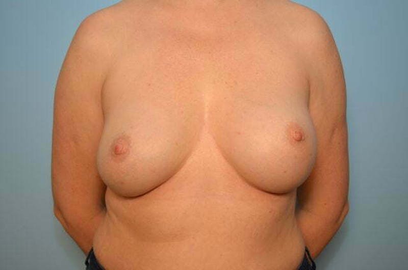 Breast Augmentation Before & After Gallery - Patient 175969 - Image 1