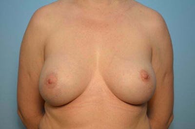 Breast Augmentation Before & After Gallery - Patient 175969 - Image 2