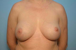 Breast Implant Removal Before & After Gallery - Patient 170722 - Image 2