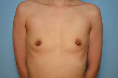 Breast Augmentation Before & After Gallery - Patient 839084 - Image 1