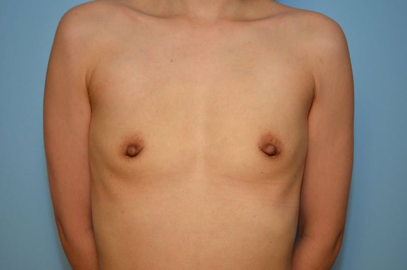 Breast Augmentation Before & After Gallery - Patient 301663 - Image 1