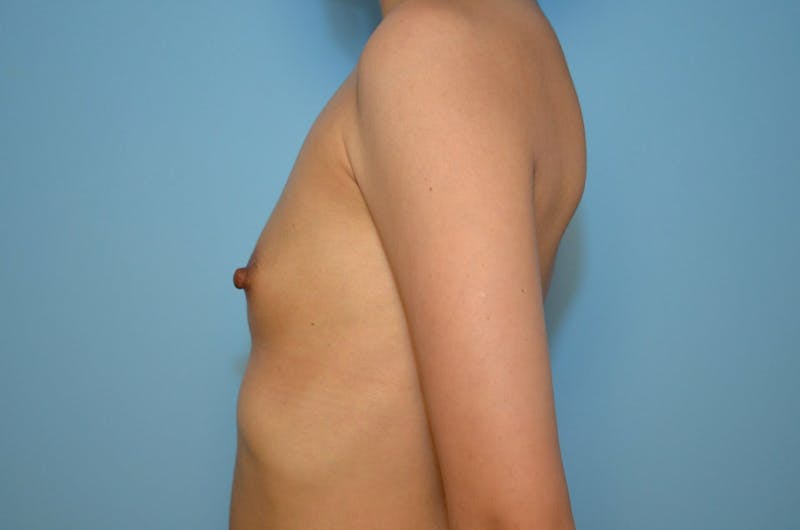 Breast Augmentation Before & After Gallery - Patient 301663 - Image 9