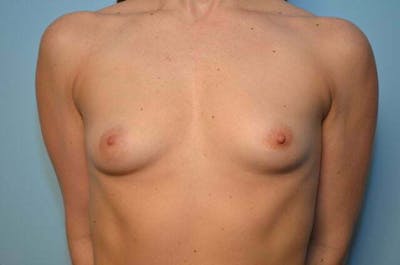 Breast Augmentation Before & After Gallery - Patient 457525 - Image 1