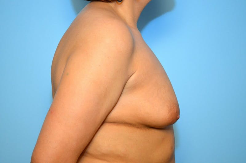 Breast Augmentation Before & After Gallery - Patient 112073 - Image 5