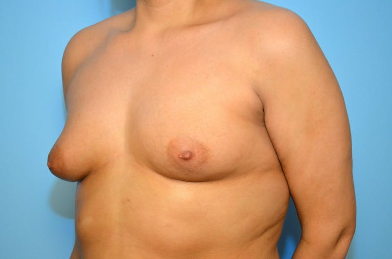Breast Augmentation Before & After Gallery - Patient 112073 - Image 7