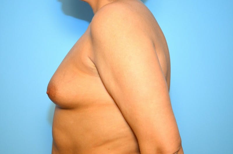 Breast Augmentation Before & After Gallery - Patient 112073 - Image 9