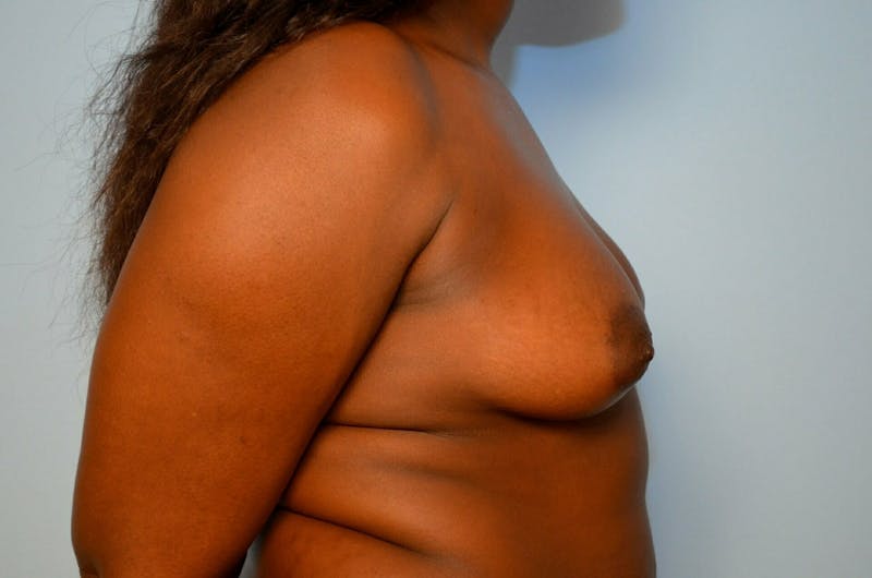 Breast Augmentation Before & After Gallery - Patient 284600 - Image 5