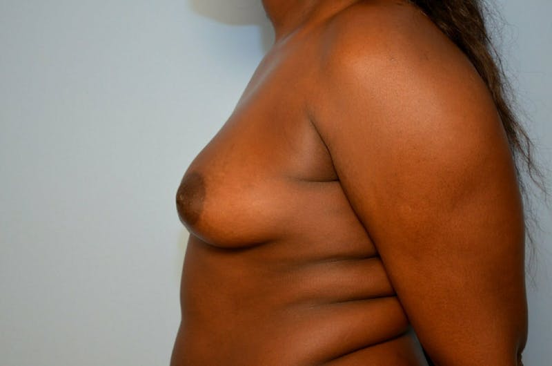 Breast Augmentation Before & After Gallery - Patient 284600 - Image 9