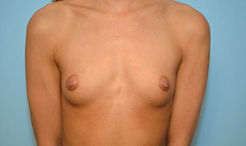 Breast Augmentation Before & After Gallery - Patient 312032 - Image 1