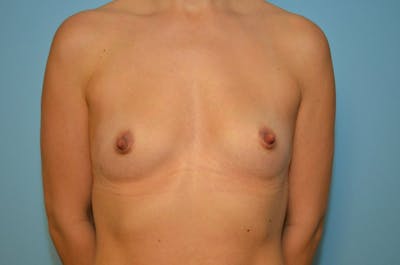 Breast Augmentation Before & After Gallery - Patient 829832 - Image 1